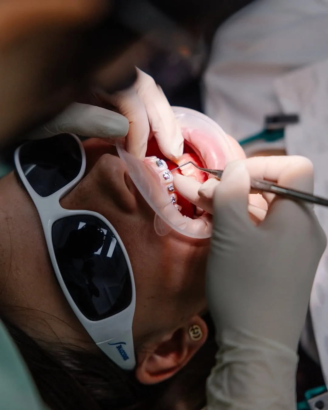 A dentist fitting metal braces to a patient’s teeth