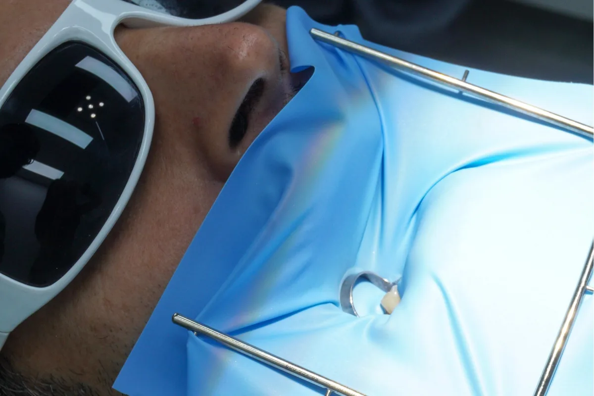 A rubber dam keeping a tooth dry during treatment