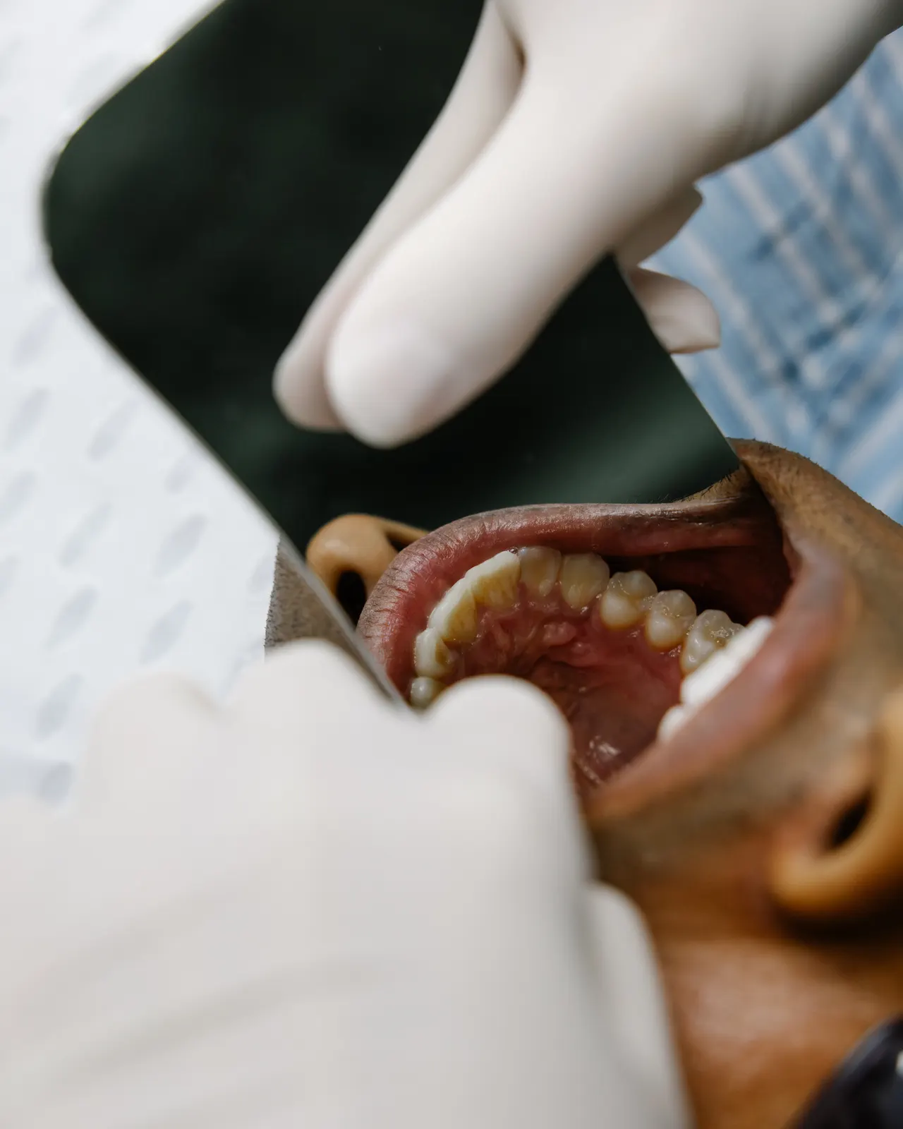Gloved hands holding a photo mirror in a patient’s mouth to photograph the teeth