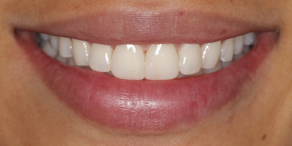 Dental Spot case 1, Four veneers, after treatment
