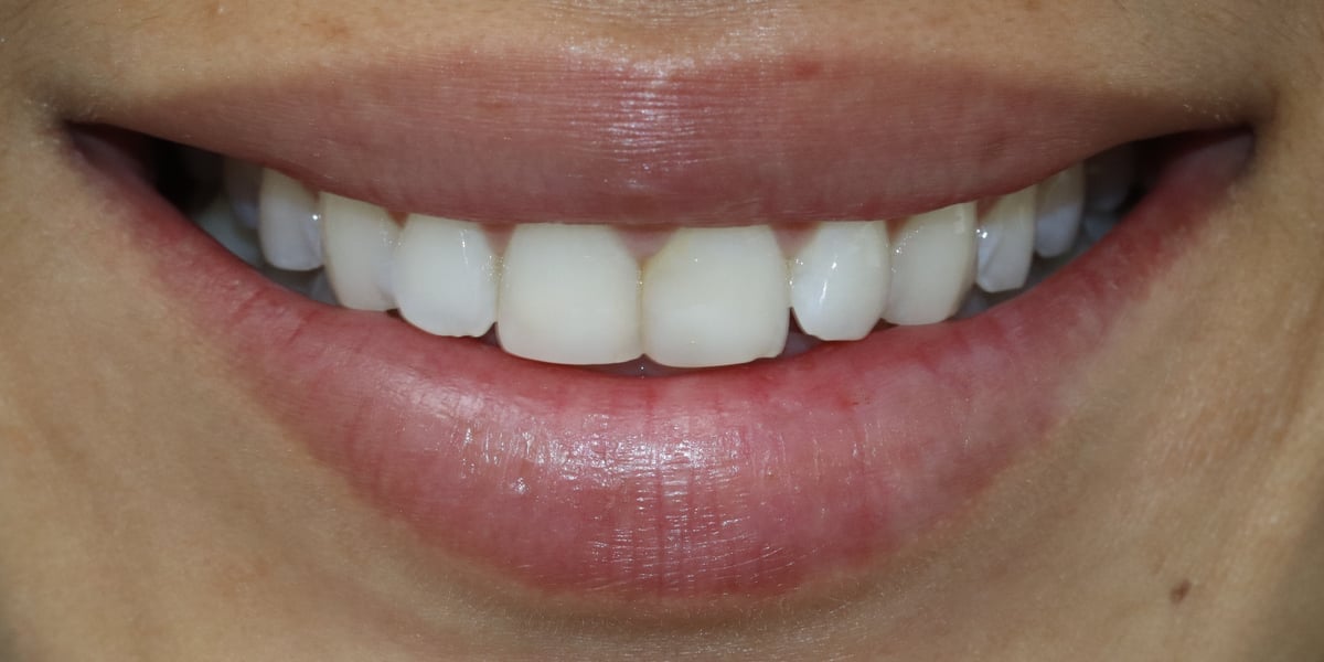 Dental Spot case 1, Four veneers, before treatment